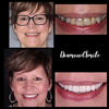 PAP+ Teeth Whitening Gel
