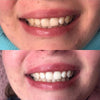 PAP+ teeth whitening gel