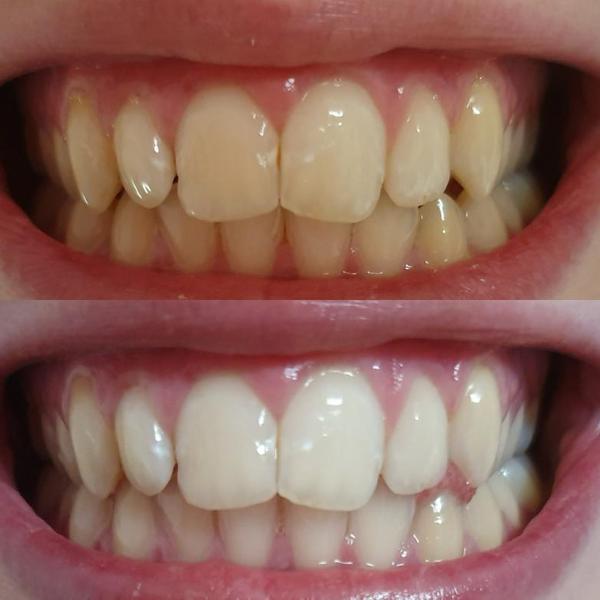 White and yellow teeth. White teeth after teeth whitening with teeth whitening gel. Teeth whitening with teeth whitening.