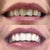 Teeth after teeth whitening.
