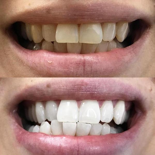 Teeth whitening for white teeth. On the picture a before and after picture of teeth after teeth whitening.
