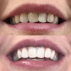Teeth whitening experience - Mouth with before picture After picture of white teeth