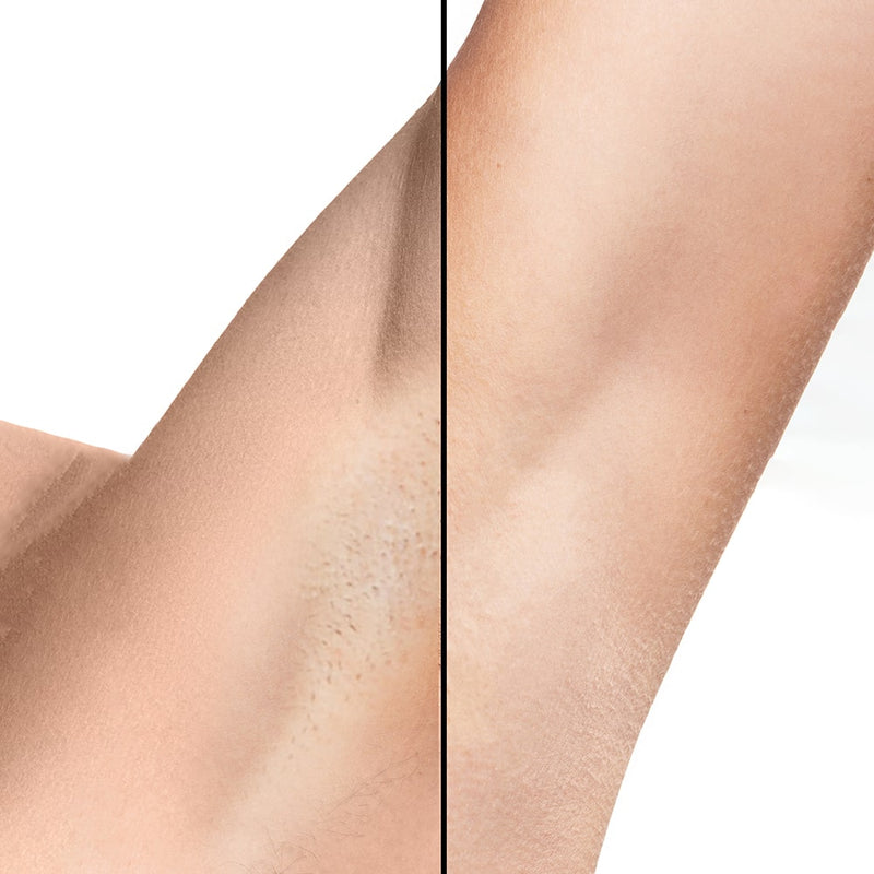 Lumi IPL Hair Remover