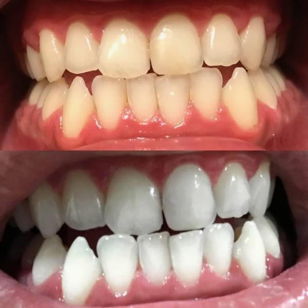 White teeth after whitening with a tooth whitening kit and tooth whitening gel.