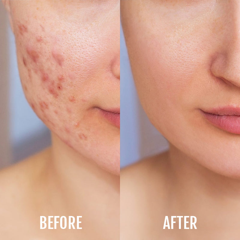 DermaClear Anti-Acne Device