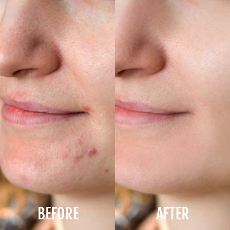 DermaClear Anti-Acne Device