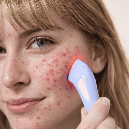DermaClear Anti-Acne Device