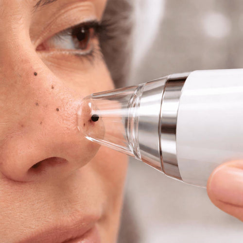 ClearCam Blackhead Remover
