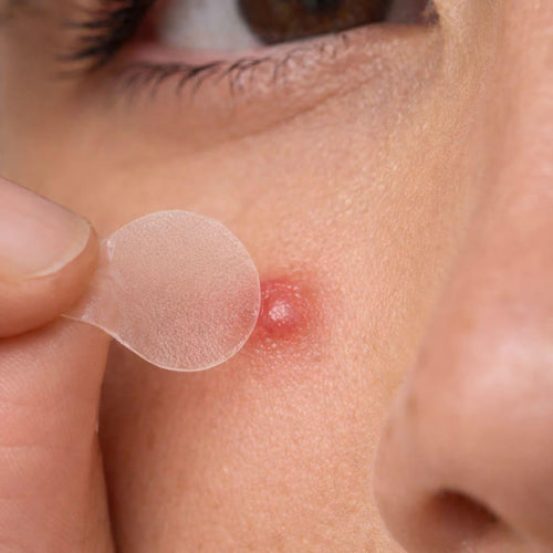 SuperClear Pimple Patches