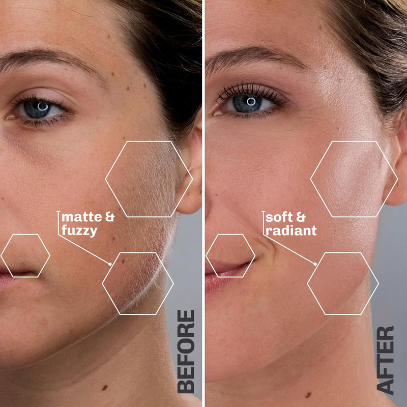 Facial hair removal device designed for convenient home use
