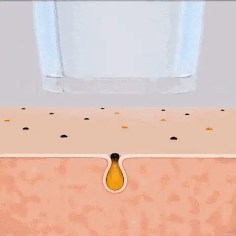 Blackhead Removal Kit