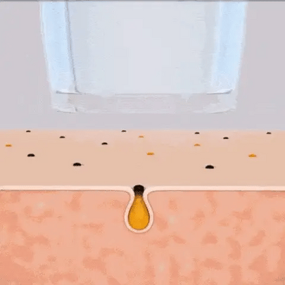 Blackhead Removal Kit