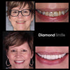 Older woman with teeth-whitening before-and-after images – Diamond Smile whitening