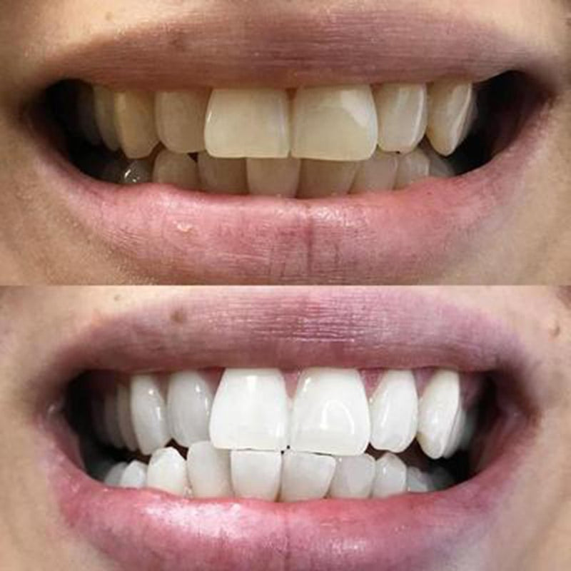 Teeth Whitening Foam