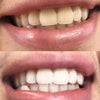 Before and after pictures of PAP+ tooth whitening set from Diamond Smile
