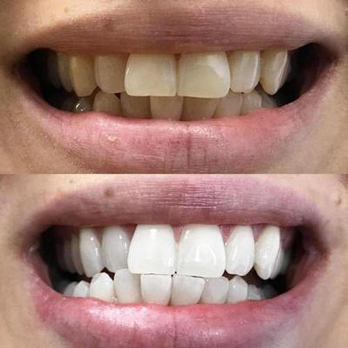 Experience Before and after pictures of PAP+ tooth whitening strips from Diamond Smile