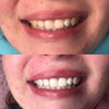 Result with the Power LED bleaching sonic toothbrush from Diamond Smile with before and after picture of tooth whitening