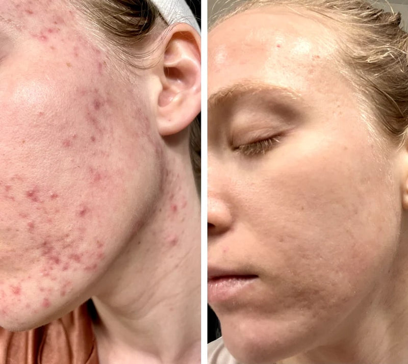 LumiDark LED Face Mask