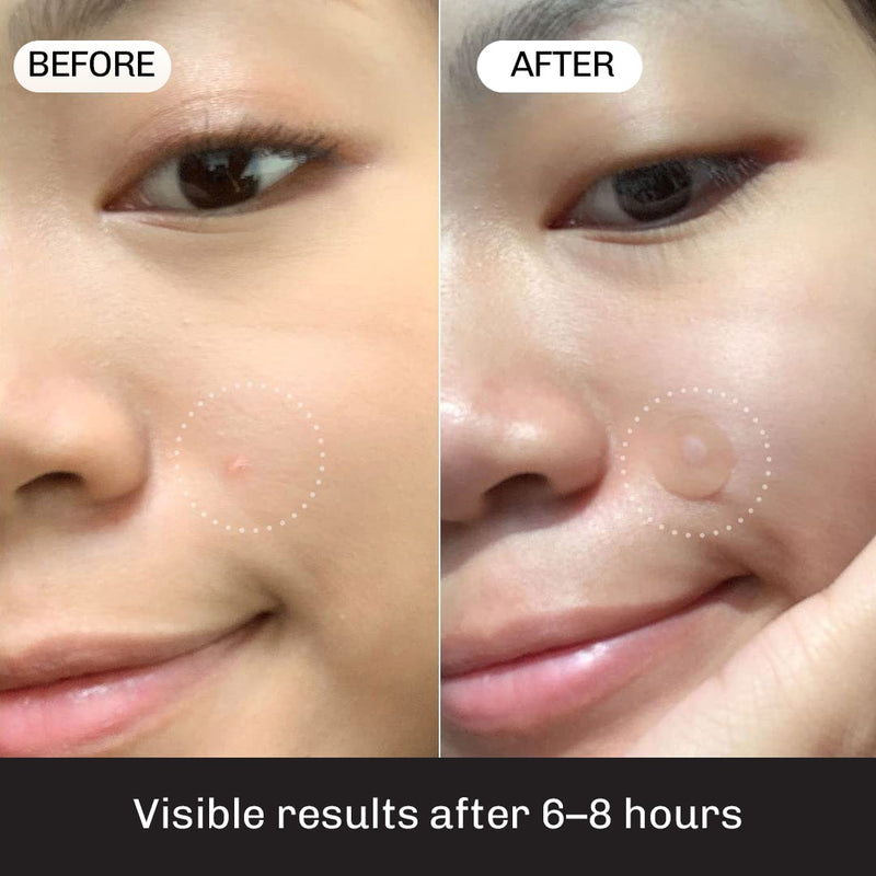 Low-visibility acne stickers that stay in place during normal daily activities