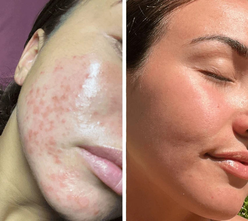 Multi-wavelength LED facial mask operating at 633 nm, 830 nm and 1072 nm