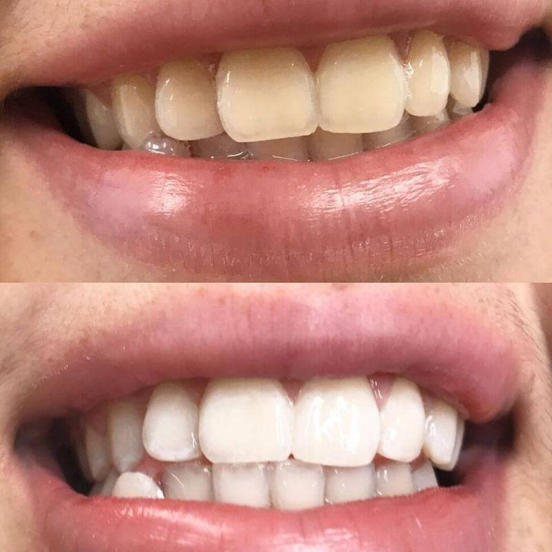 Experience of the Power LED bleaching sonic toothbrush from Diamond Smile with before and after picture of tooth whitening