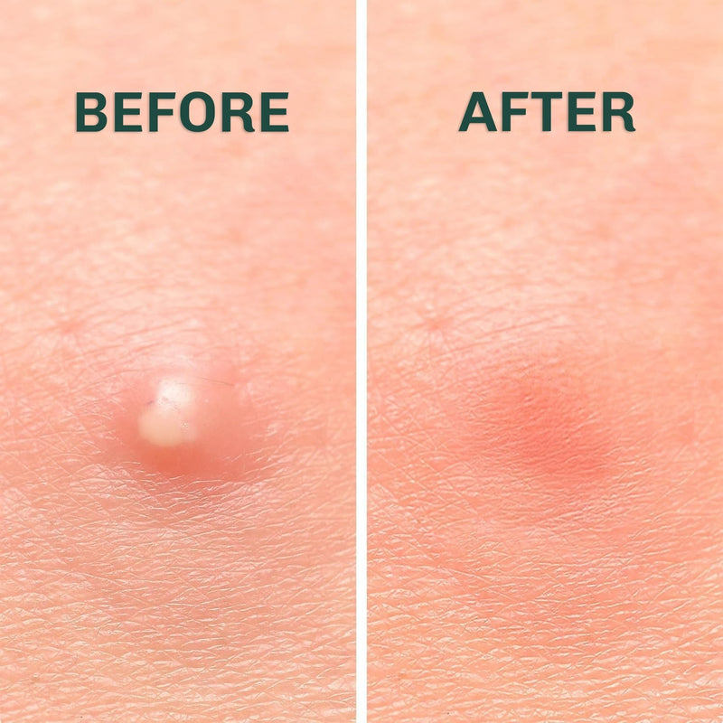 SuperClear Pimple Patches