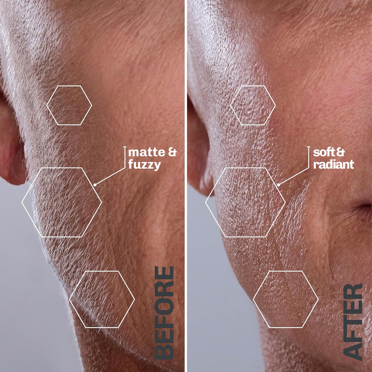 Ultrasonic Hair Removal