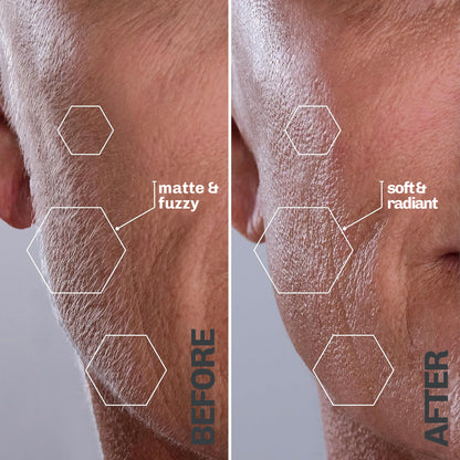 Ultrasonic Hair Removal