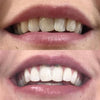 Hollywood Teeth Whitening Kit