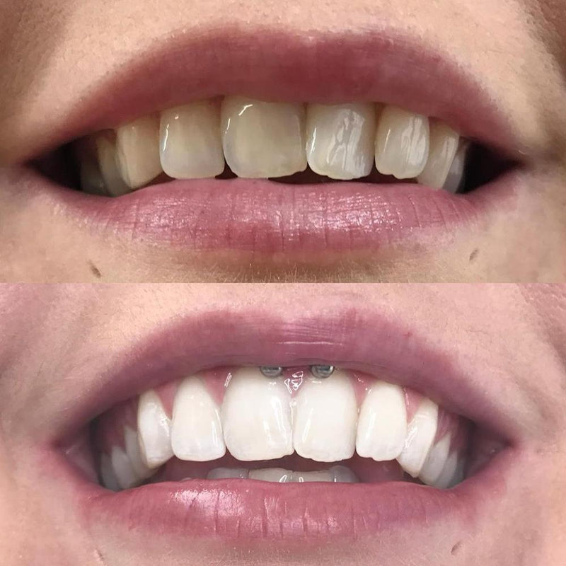 Hollywood Teeth Whitening Kit