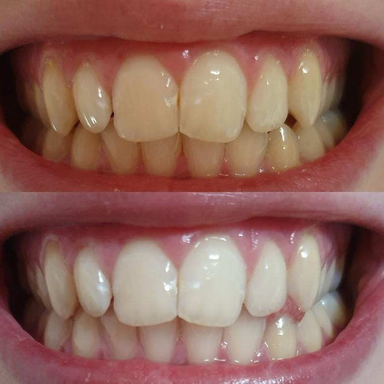 White and yellow teeth.
White teeth after whitening with teeth-whitening gel.
Whiten teeth through teeth whitening.