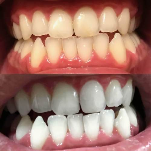 Activated Charcoal Whitening Strips