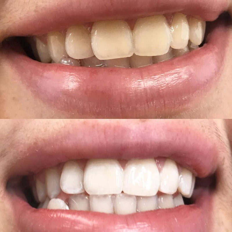 Premium Teeth Whitening Kit