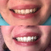 Premium Teeth Whitening Kit