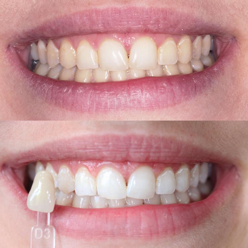 White teeth from teeth whitening. Images of a woman after teeth whitening.