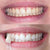White teeth due to teeth whitening. Pictures of a woman after teeth whitening.