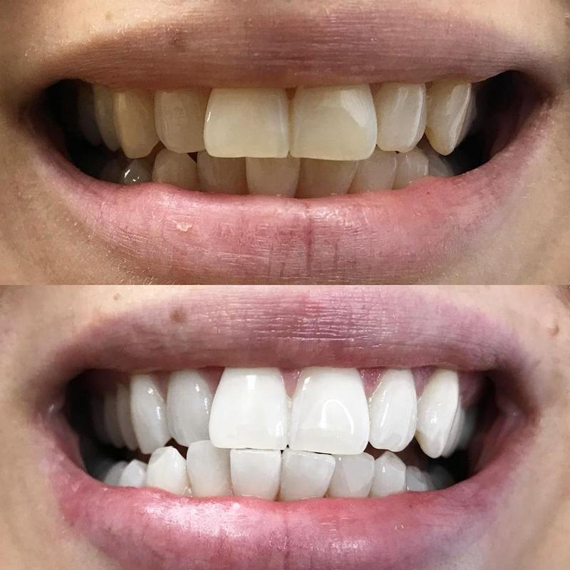Whiten teeth for white teeth. The image shows a before-and-after of teeth following a teeth-whitening treatment.