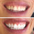 White teeth after whitening the teeth with a teeth whitening kit.