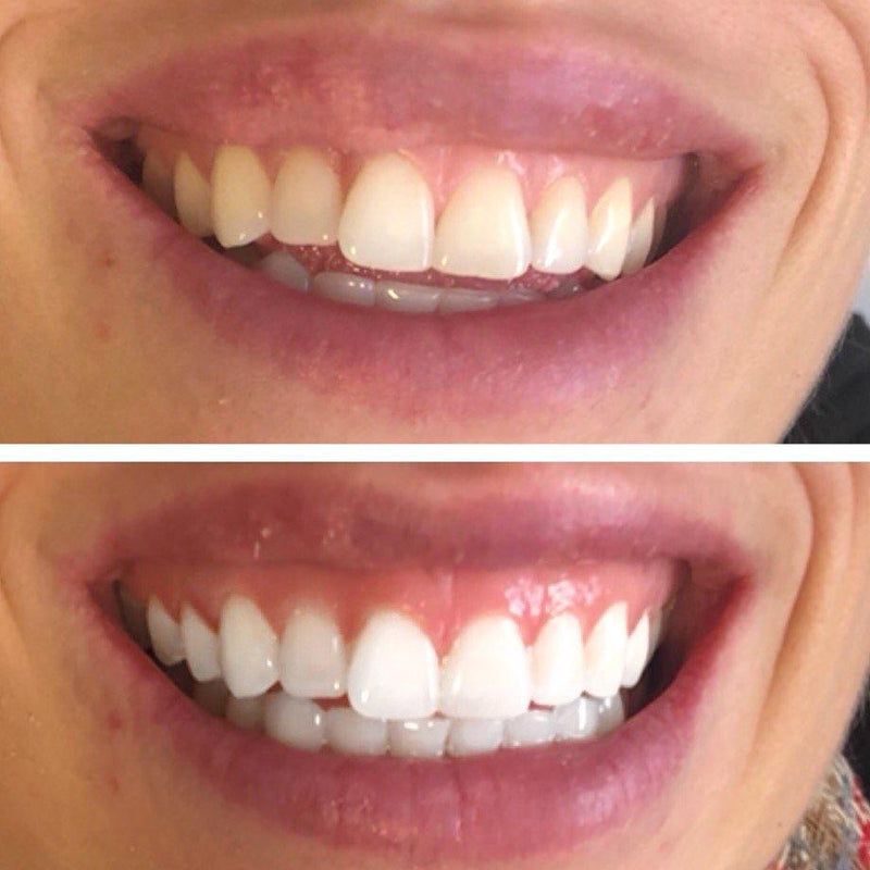 White teeth after whitening with a teeth-whitening set.