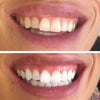 Tooth Whitening Strips for White Teeth