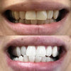 Tooth whitening with tooth whitening strips