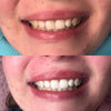 Tooth Whitening with Diamond Tooth Whitening Gel