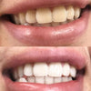 White teeth through tooth whitening