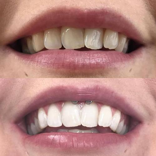 Teeth whitening experience - Mouth with before picture After picture of white teeth