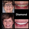 Result Diamond Smile tooth whitening color correction foam - Before picture After picture of white teeth