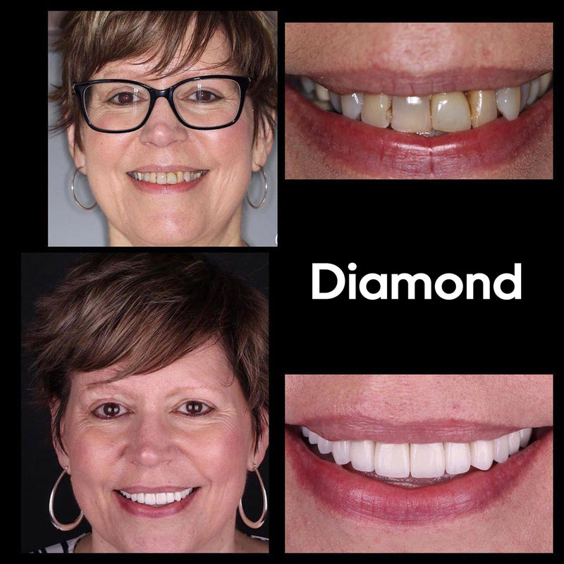 Result Diamond Smile tooth whitening color correction foam - Before picture After picture of white teeth