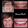 Teeth Whitening from Home - Bleaching Set
